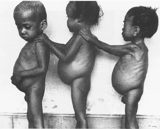 Image result for kwashiorkor